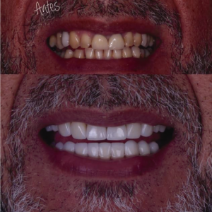 nuevo-dientes-2